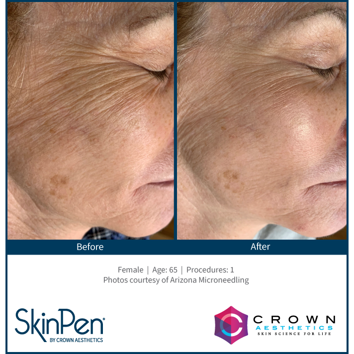 SkinPen® Microneedling Face, Neck & Decollette Course of 6