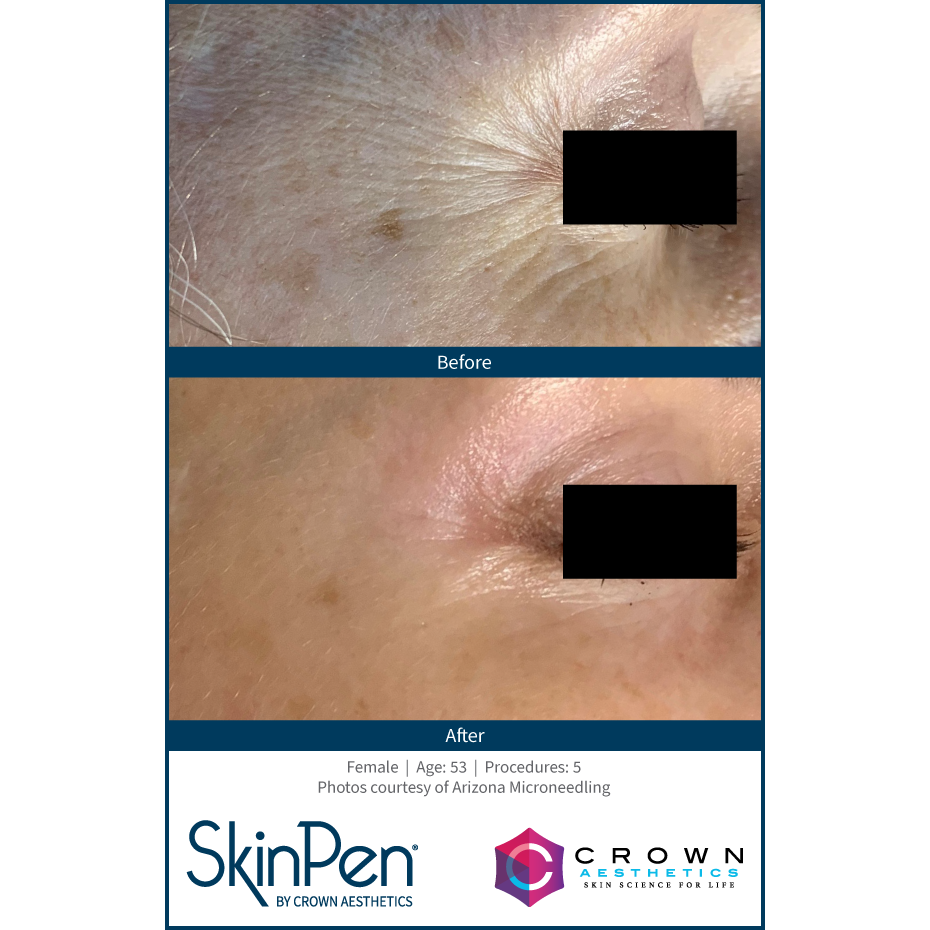 SkinPen® Microneedling Face, Neck & Decollette Course of 6