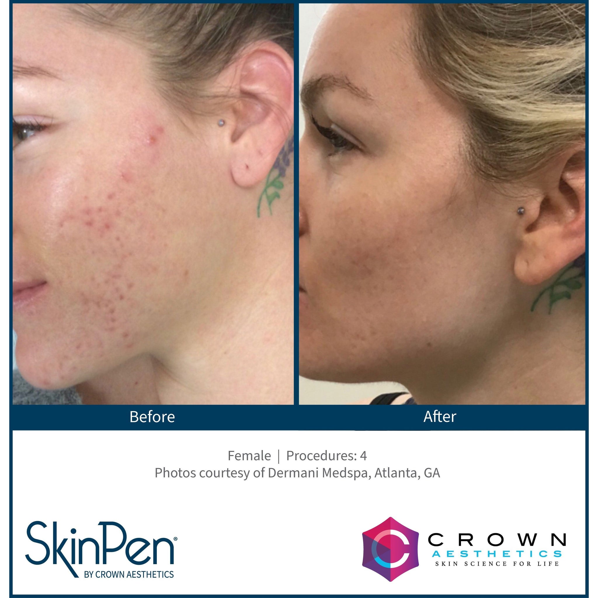 SkinPen® Microneedling Face, Neck & Decollette Course of 6