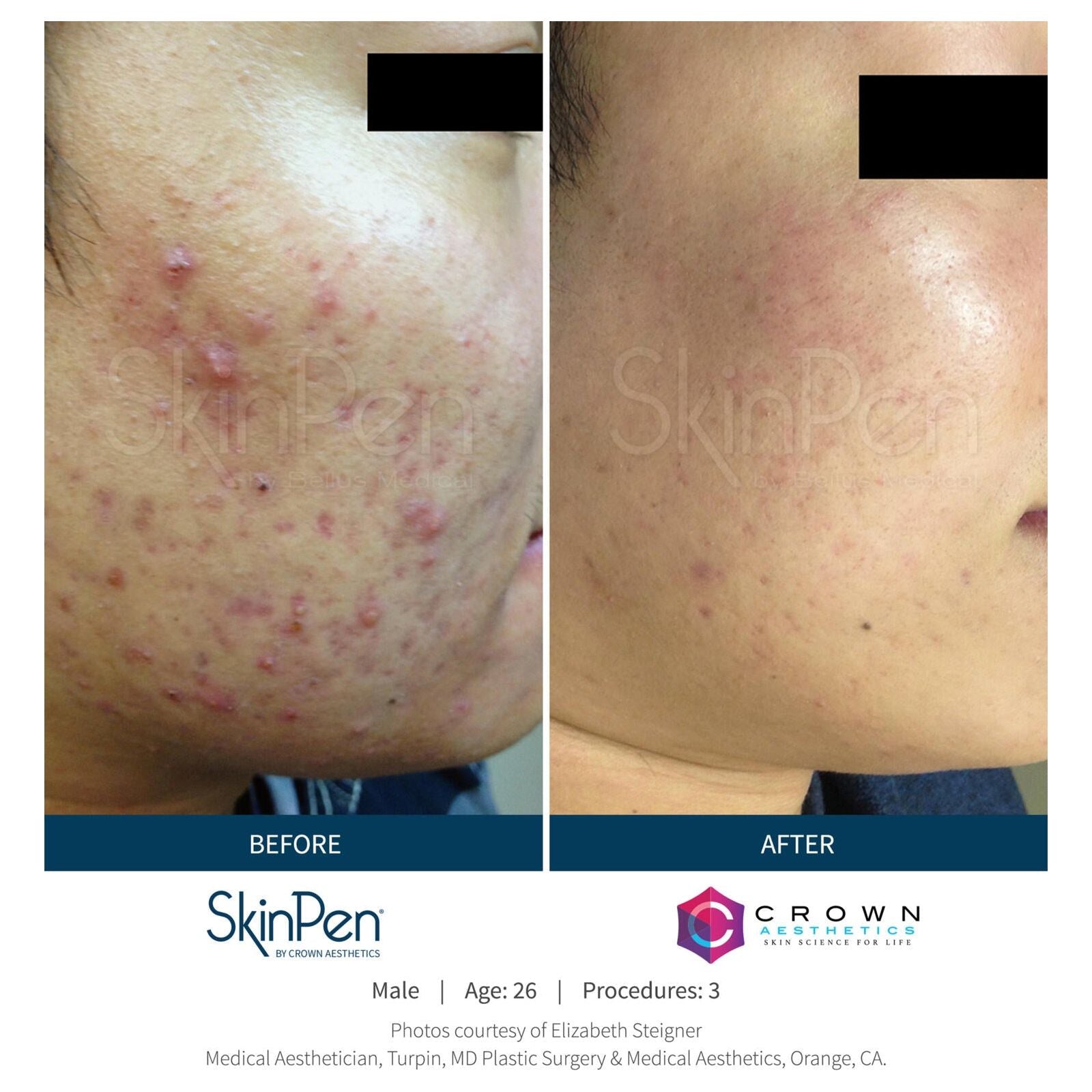 SkinPen® Microneedling Face, Neck & Decollette