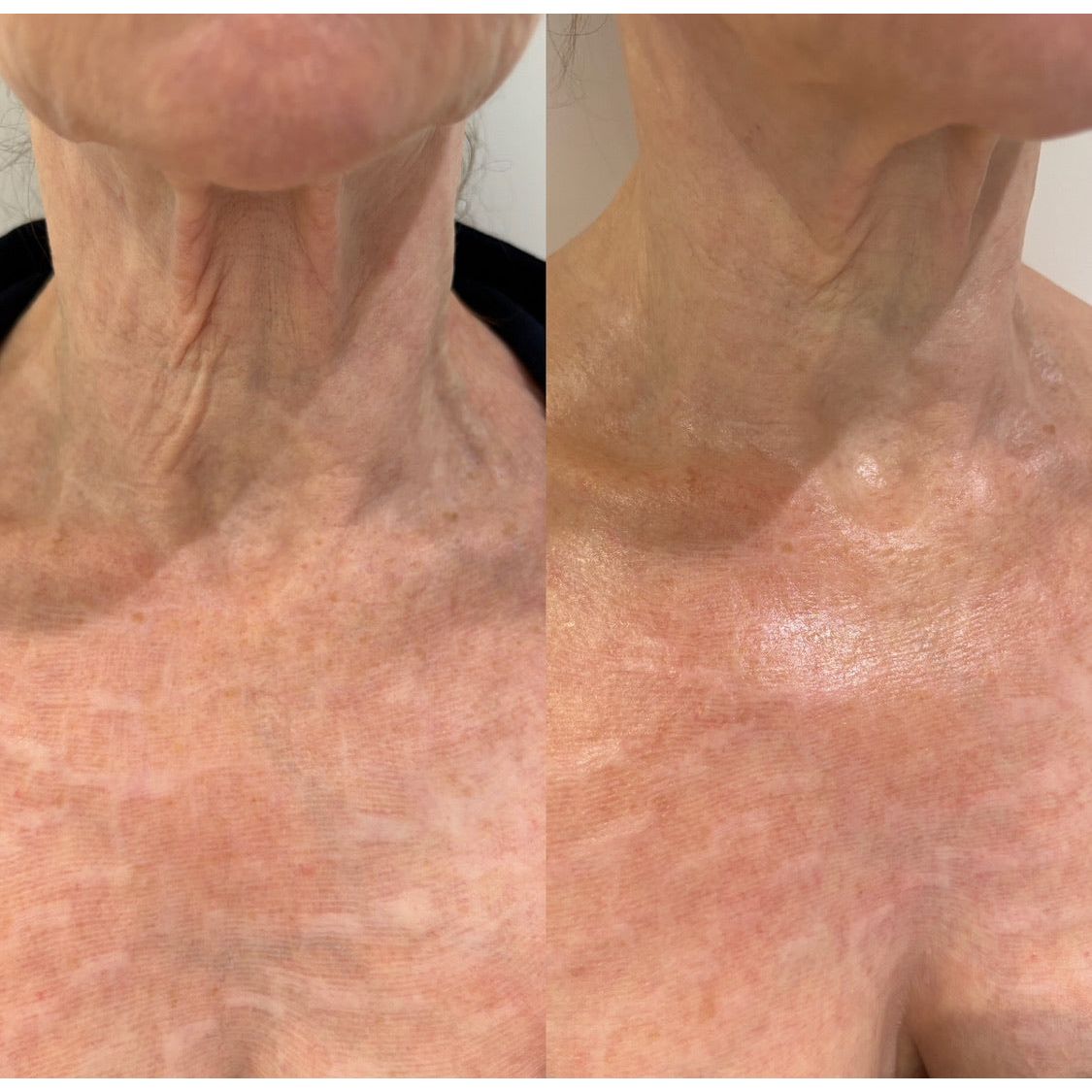 SkinPen® Microneedling Face & Neck