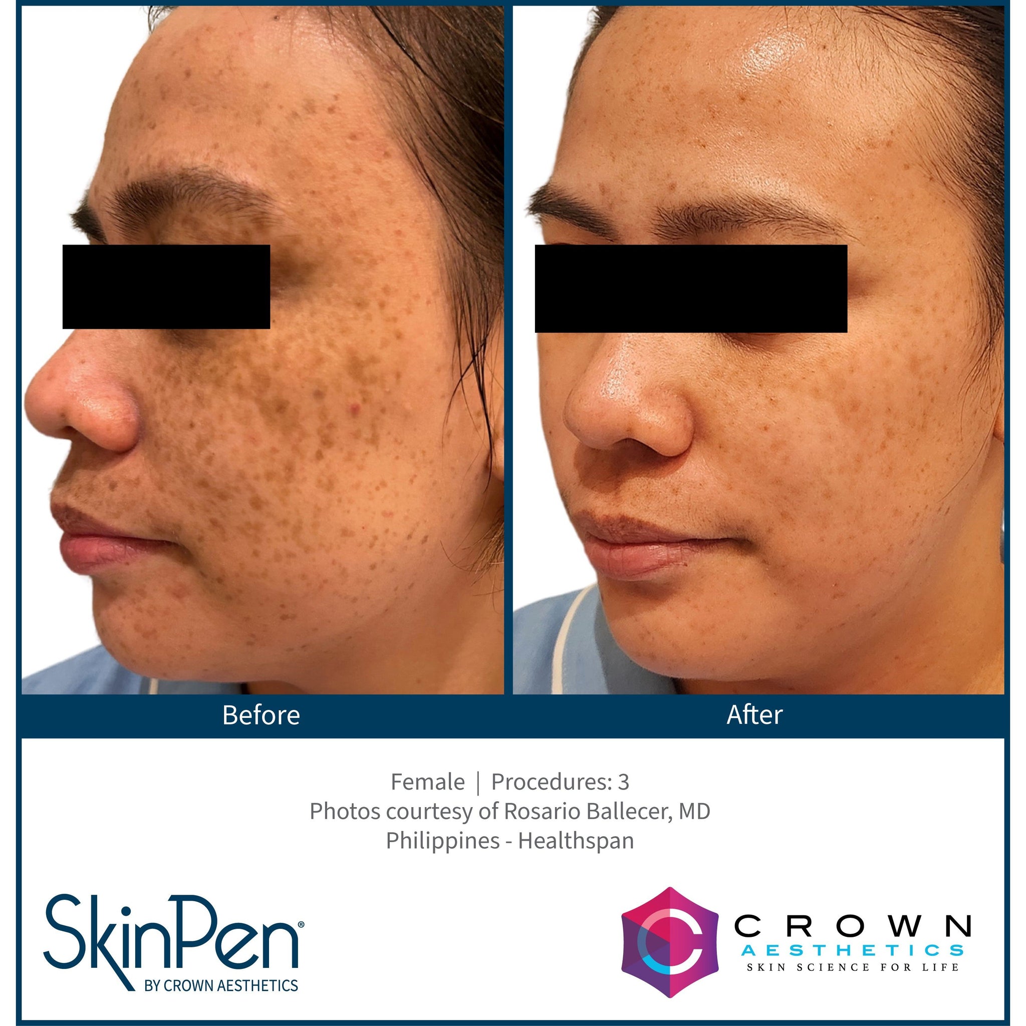 SkinPen® Microneedling Face, Neck & Decollette Course of 6